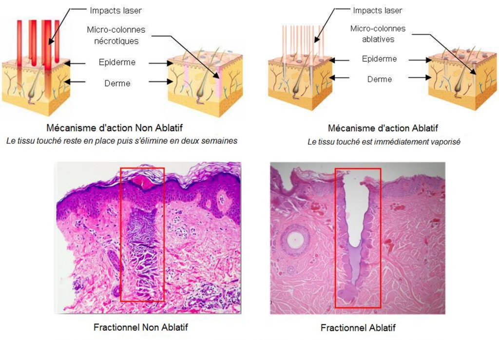 laser-rajeunissement-mecanisme