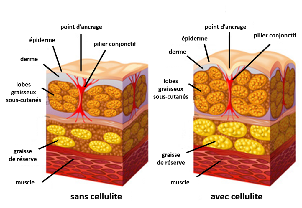 CELLULITE