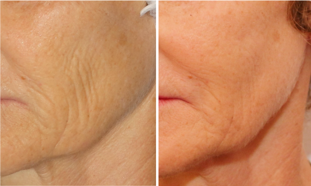 Rides Du Visage Docteur Rygaloff Rides Du Visage Docteur Rygaloff