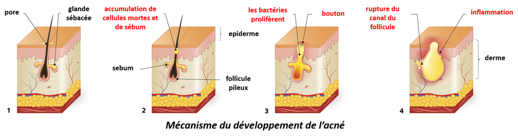 MECA DEVPT ACNE