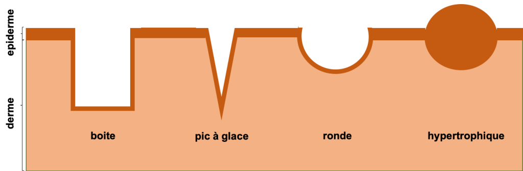 TYPES CICACNE