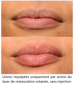SMOOTH-LIPS-AVAP-1-LEGEND-260x300